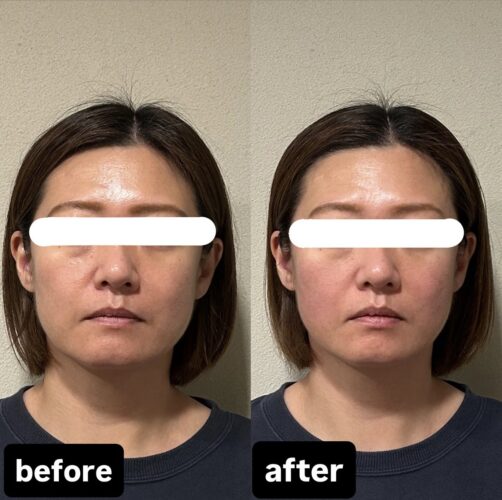美容鍼＋小顔矯正【ビフォーアフター】