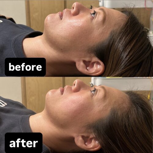 むくみ・たるみ・くすみに一度にアプローチ【美容鍼】