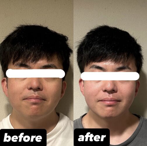 【美容鍼＋小顔矯正+美容整体】4回目ビフォーアフター