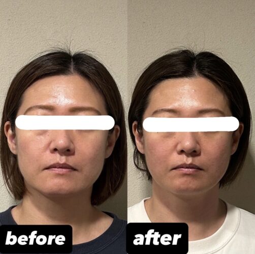 【定着する小顔を目指したい方】美容鍼＋小顔矯正4回