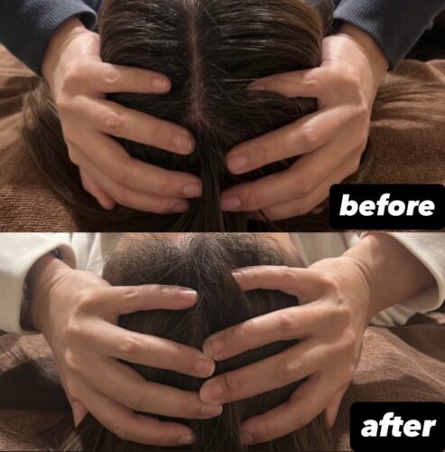 【小顔矯正は頭も小さく】4回美容鍼＋小顔矯正