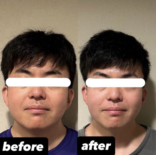 男性、女性にも大人気美容鍼！目黒/恵比寿